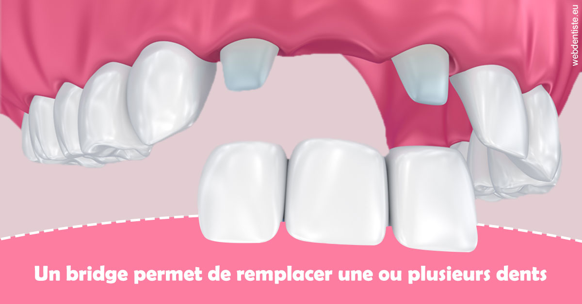 https://dr-christophe-schohn.chirurgiens-dentistes.fr/Bridge remplacer dents 2