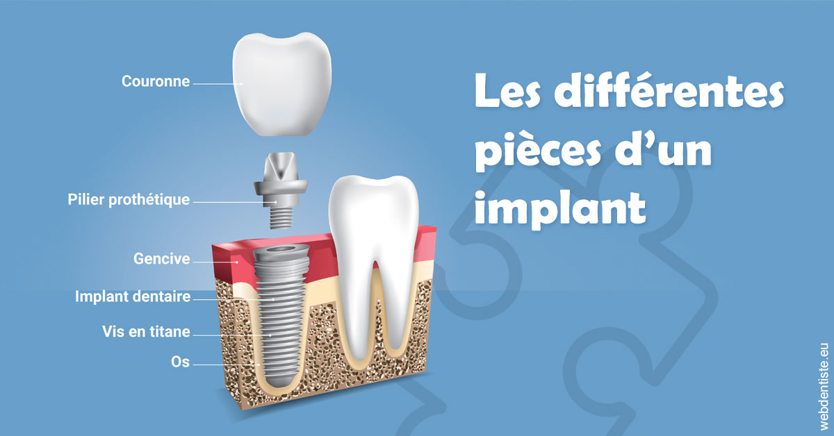 https://dr-christophe-schohn.chirurgiens-dentistes.fr/Les différentes pièces d’un implant 1