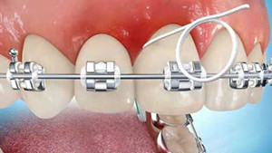 Hygiène et appareil dentaire orthodontique